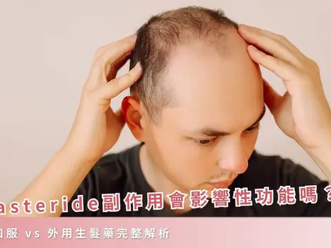Finasteride 副作用會影響性功能嗎？柔沛口服 vs 外用生髮藥完整解析