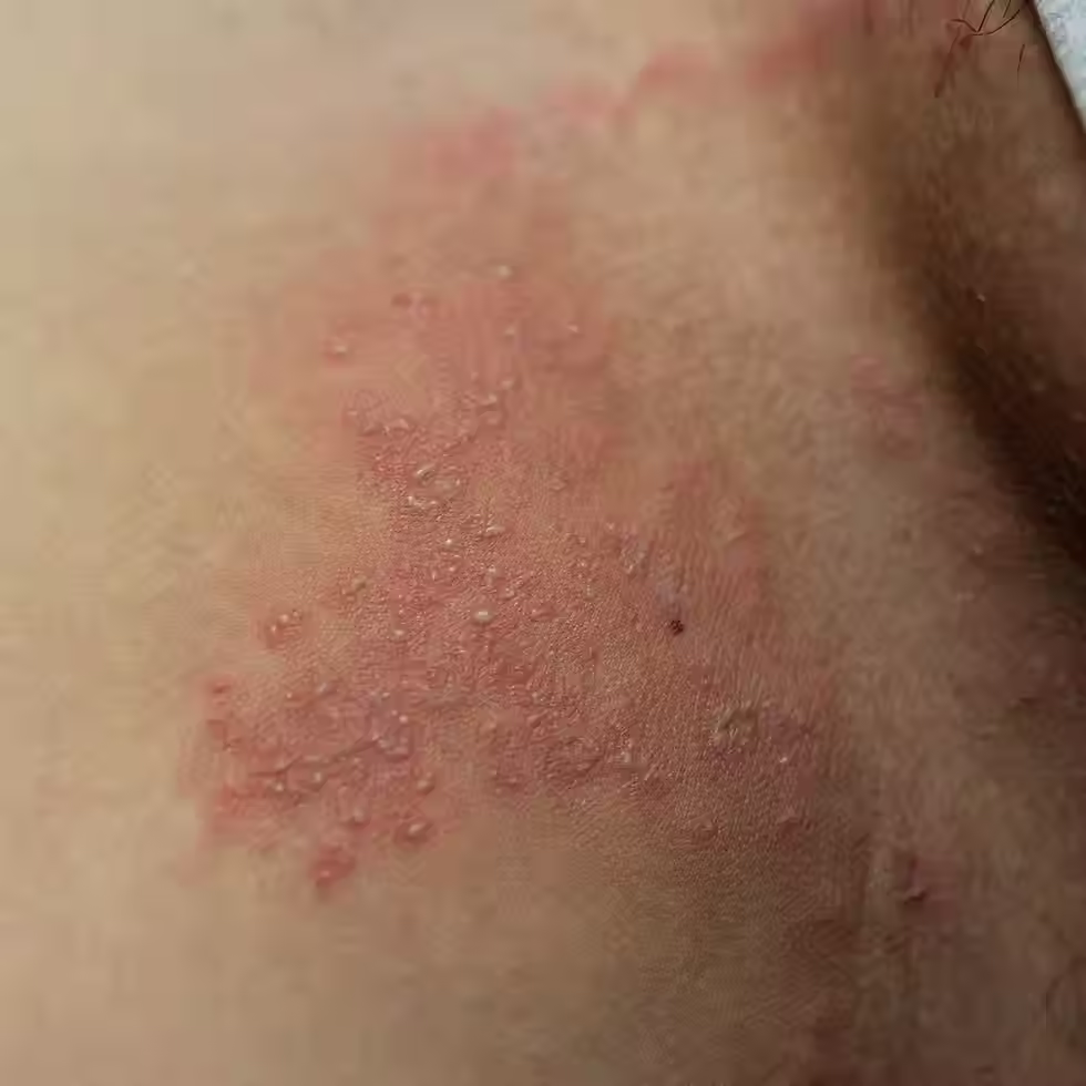 股癬常見症狀示意,鼠蹊部皮膚出現紅疹、脫屑與邊緣較明顯病灶