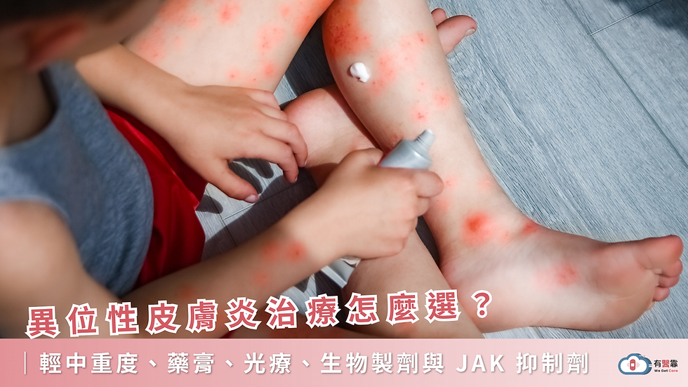 異位性皮膚炎治療怎麼選?輕中重度、藥膏、光療、生物製劑與 JAK 抑制劑