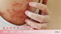 異位性皮膚炎是什麼？症狀、原因、治療、飲食與照護一次看懂