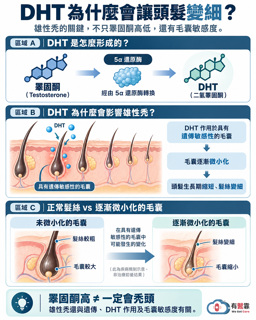 睪固酮經5α還原酶轉換為DHT,並作用於遺傳敏感毛囊,造成毛囊逐漸微小化與髮絲變細的示意圖