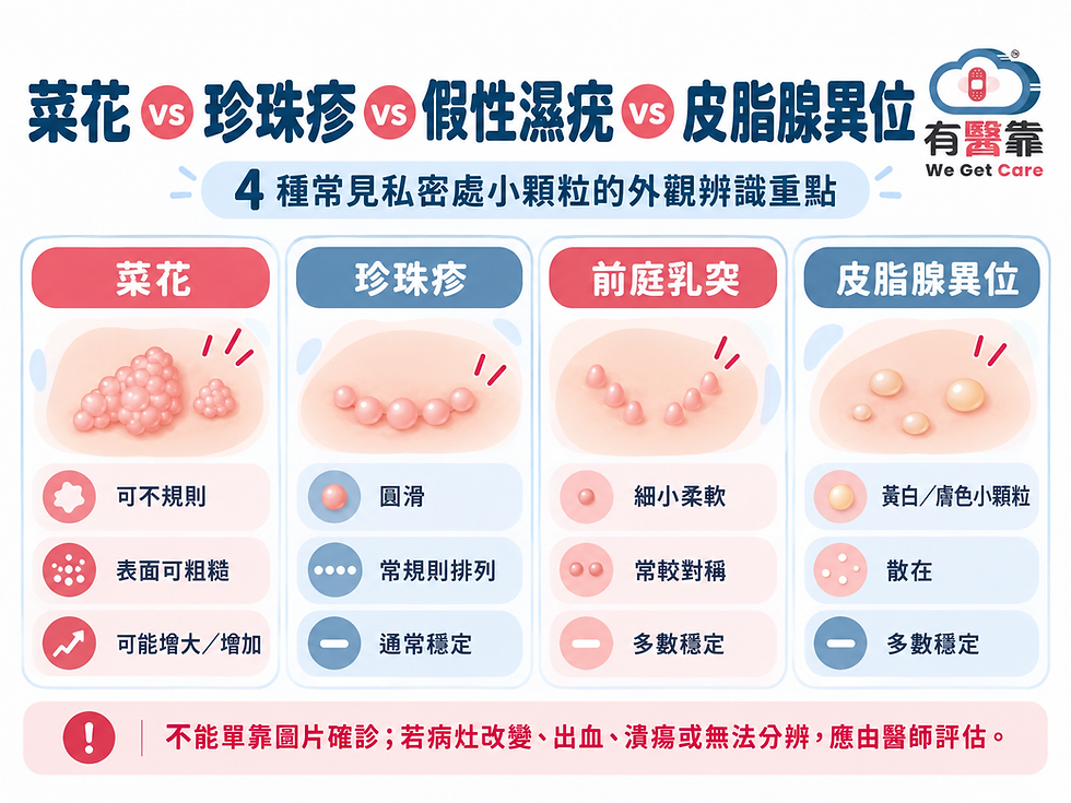 菜花、陰莖珍珠疹、前庭乳突與皮脂腺異位的外觀排列與變化差異示意圖