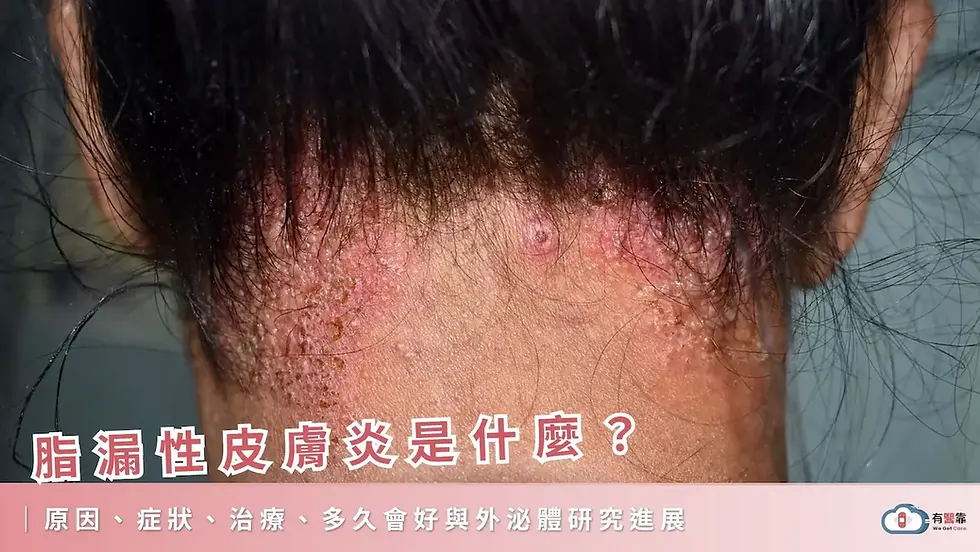 脂漏性皮膚炎是什麼?原因、症狀、治療、多久會好與外泌體研究進展