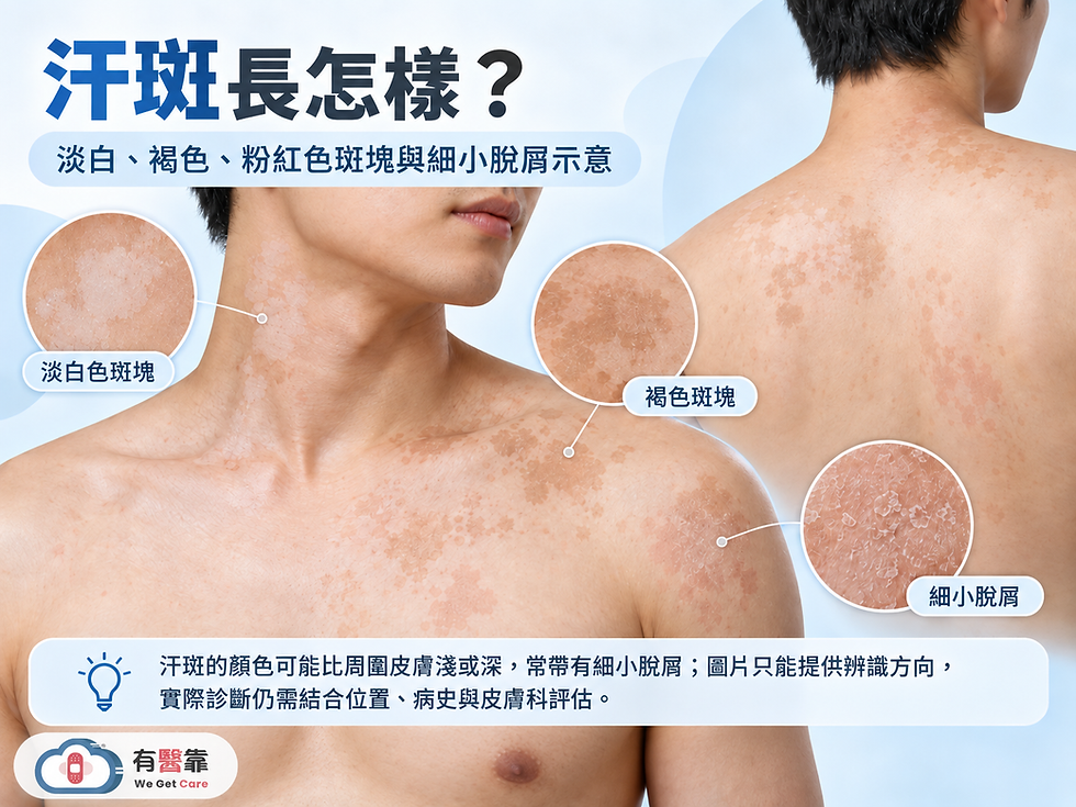汗斑外觀示意圖,呈現淡白色、褐色與粉紅色斑塊,表面可見細小脫屑