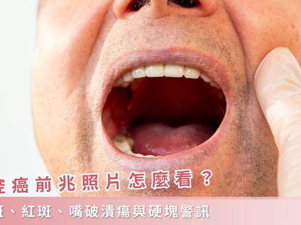 口腔癌前兆照片怎麼看？白斑、紅斑、嘴破潰瘍與硬塊警訊