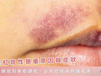 解密紅斑性狼瘡原因與症狀：從蝴蝶斑到免疫調控，必知症狀與照護指南