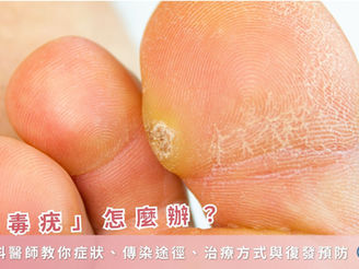 病毒疣怎麼辦?皮膚科醫師教你症狀、傳染途徑、治療方式與復發預防