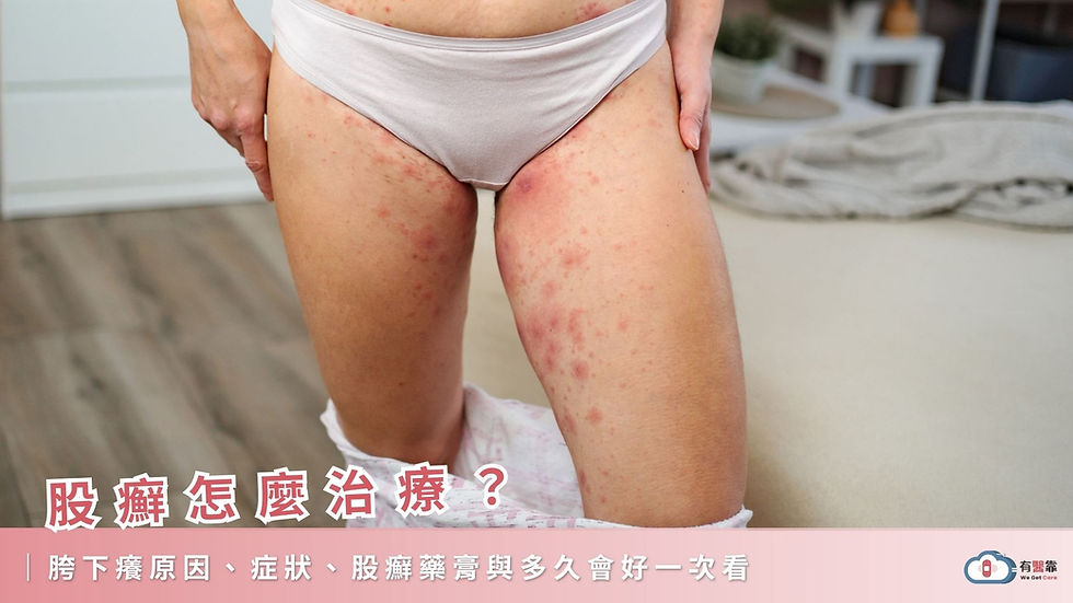 股癬怎麼治療?胯下癢原因、症狀、股癬藥膏與多久會好一次看