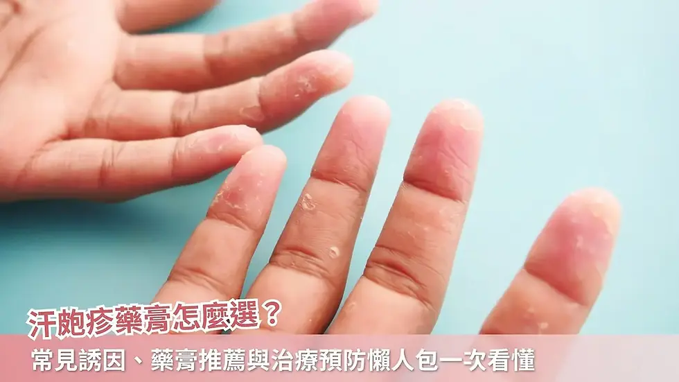 汗皰疹藥膏怎麼選?常見誘因、藥膏推薦與治療預防懶人包一次看懂