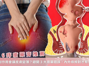 2026 痔瘡藥膏推薦｜類固醇副作用會讓皮膚變薄？避開3大用藥錯誤，內外痔擦對才有效