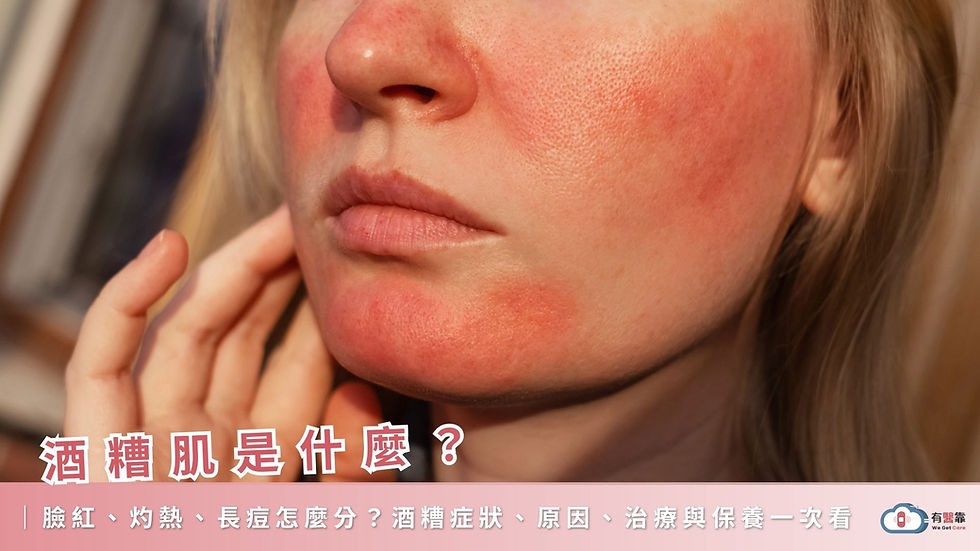 酒糟肌是什麼?臉紅、灼熱、長痘怎麼分?酒糟症狀、原因、治療與保養一次看