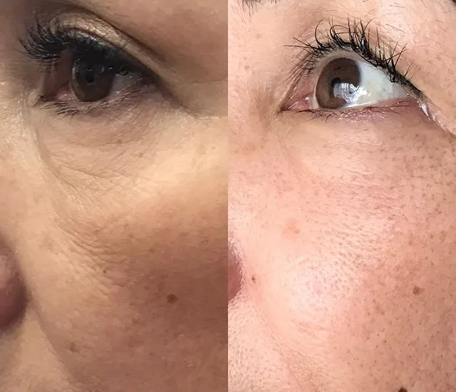 Fibroblast Skin Tightening West Losangeles Yuribeauty9 Com Bye Bye