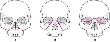phy_le_fort_midface_fractures_pt.gif