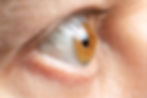 ceratocone.jpg