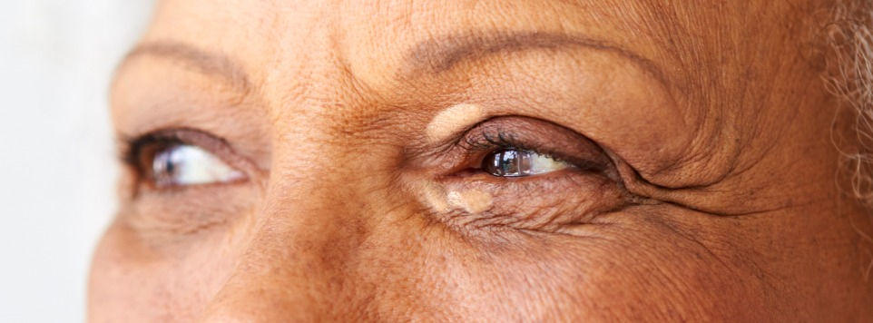 Xantelasma