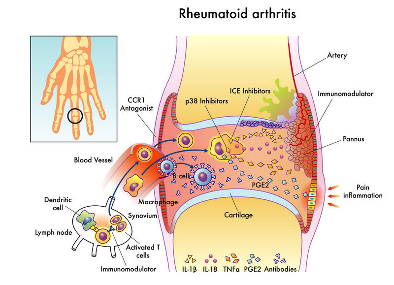 Difference between Rheumatoid arthritis and Osteoarthritis Dr. Benji