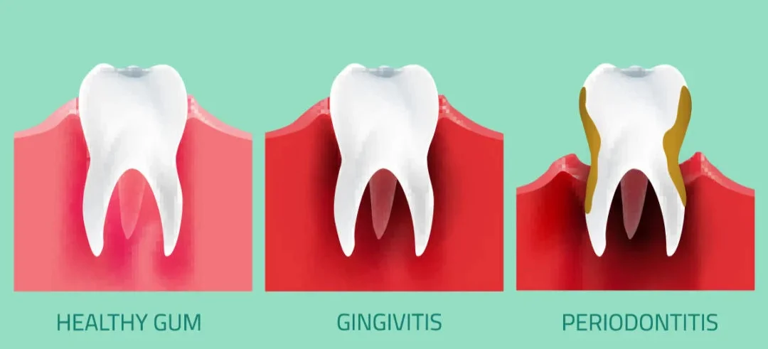 Periodontist Briarcliff Manor, periodontal treatment dentist