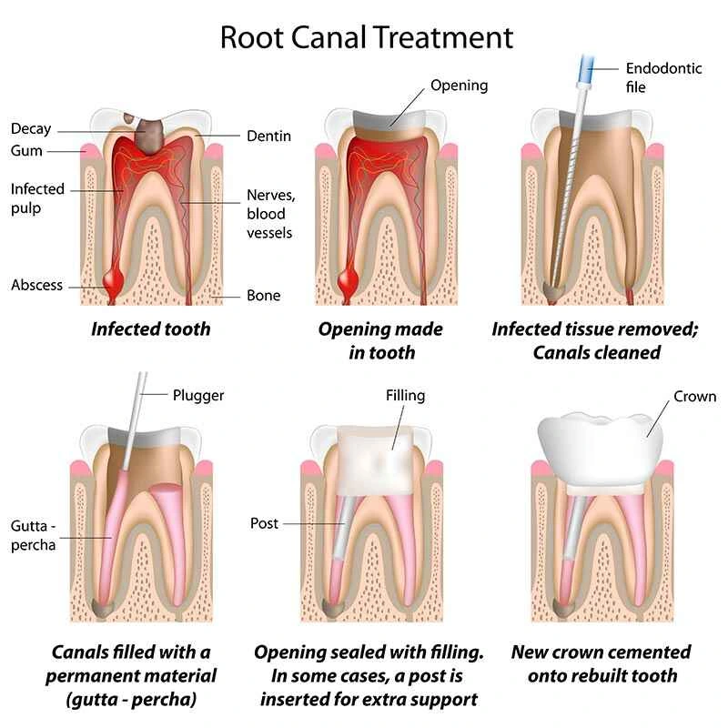 root canal treatment briarcliff manor, root canal dentist, endodontist near me