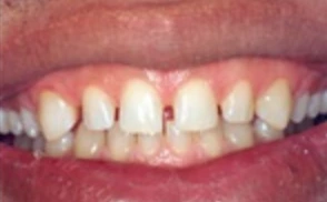 cosmetic dentist veneers , veneers dental treatment in briarcliff manor