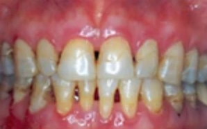 veneers briarcliff manor, cosmetic dentist in briarcliff manor