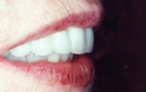 dental crowns briarcliff manor