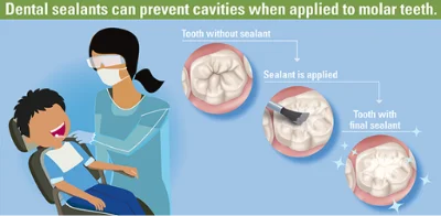 sealants briarcliff manor, pediatric dental sealants, briarcliff smile design