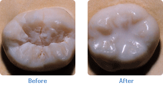 dental sealants before and after, pediatric dentistry