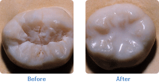 dental sealants before and after