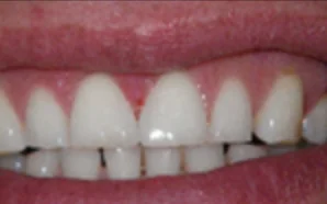 Tooth bonding Briarcliff Manor, cosmetic dentist in briarcliff manor
