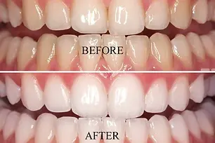 teeth whitening dentist, dentist in briarcliff manor, best dentist for teeth whitening in briarcliff manor