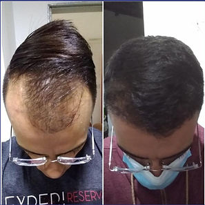 Implante capilar preço