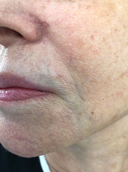 ENDOLASER, LASER, safena, varizes, microvarizes, Belo Horizonte, Mater Dei, Paulo Bastianetto, veias doentes, microvarizes, aplicação