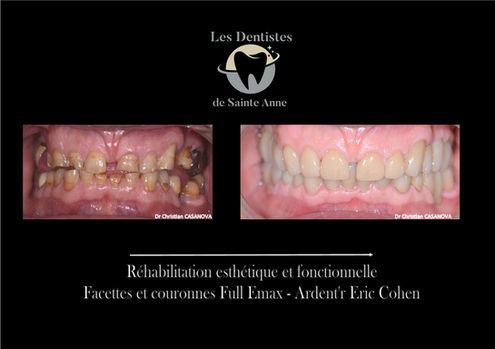 Frassanito - Facettes Couronnes.jpg