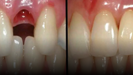 Lamtumirë, probleme dentare: Teknika që rrit dhëmbin e rënë në vetëm 10 javë!