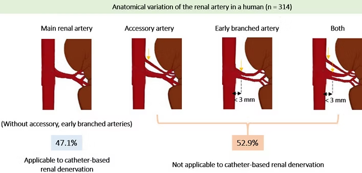 카테터 기반의 RDN 치료법은 현재 보조 및 분지 동맥을 가진 고혈압 환자에게는 적합하지 않습니다. 그러나 DeepQure의 HyperQure 기술은 이 시술의 접근성을 높여 보험 급여 체계를 형성하는데 도움이 될 것입니다.