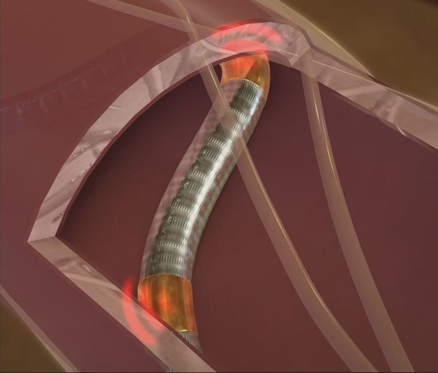catheter.JPG