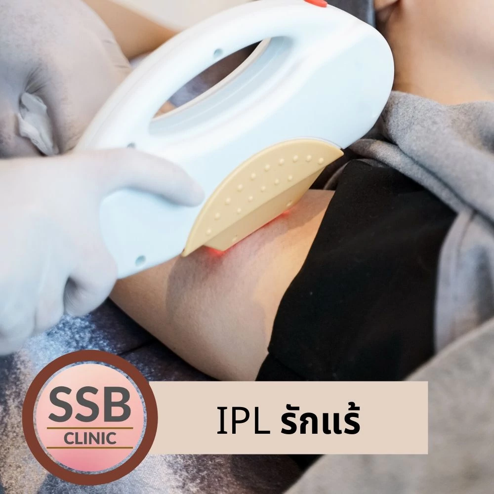รักแร้หนังไก่ ssbclinic