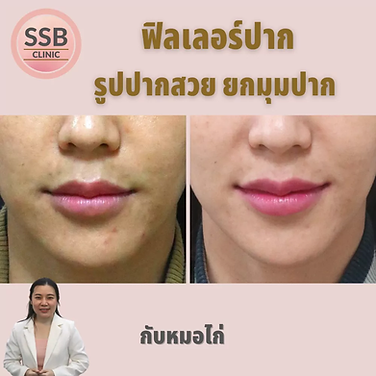 lip filler ssbclinic