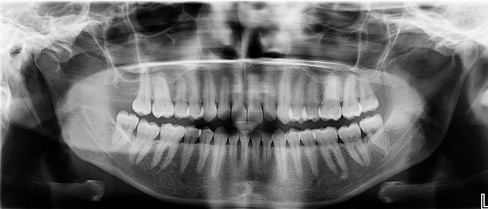 radiographie panoramique orthodontie cannes le cannet