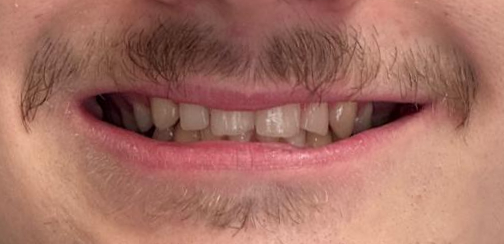 Gaps closed with Invisalign clear aligners