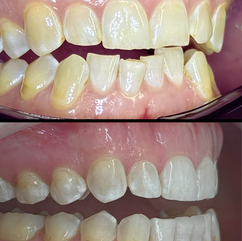 Before and After showing composite bonding to repair worn and chipped teeth