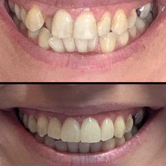 Before and After of a Smile Makeover using Composite Bonding with Invisalign