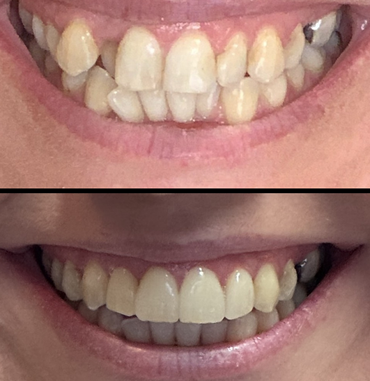 Smile Makeover with Invisalign, Tooth Whitening and Composite Bonding in Halesworth