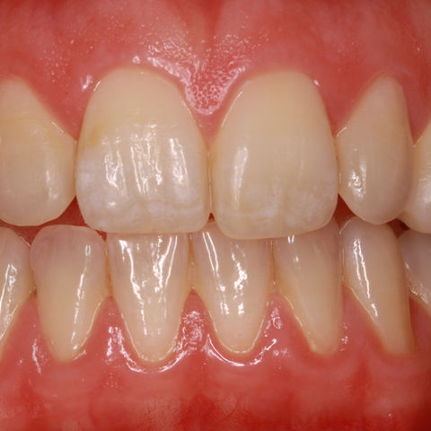 Invisalign