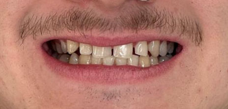 Can Invisalign Fix Gaps in Teeth? What Patients in Halesworth Need to Know