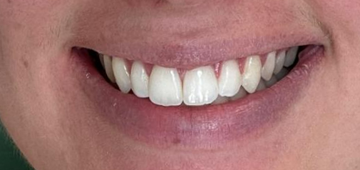 Teeth aligned and overbite corrected with Invisalign