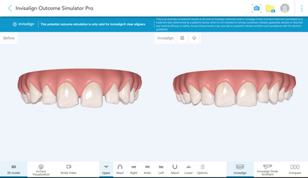 Invisalign Outcome Simulator
