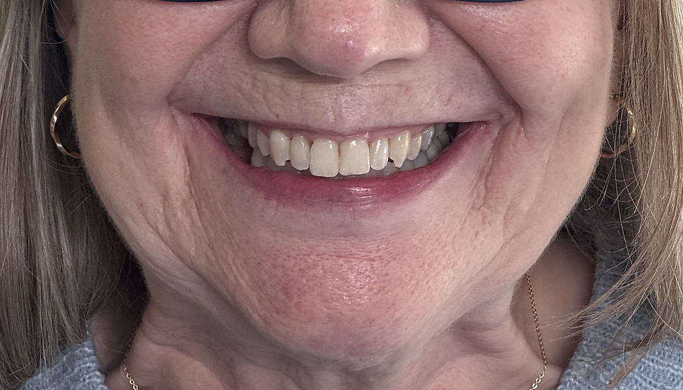 27599714_5_Wide_Smile post op cropped