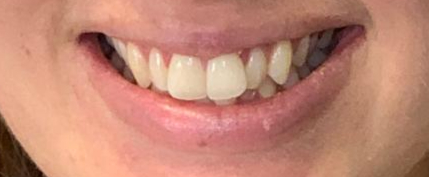 Smile with crowding and an overbite
