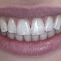 Clear Aligners Before & After Halesworth
